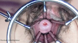 First Insertion: The Extremity Dildo. Spreader Pussy Held Wide Open. Cervix Showing. Speculum.